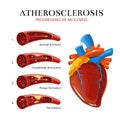 Atherosclerosis, blood clot formation. Vector medical illustration