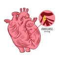 ATHEROSCLEROSIS Chronic Disease Medicine Education Diagram Royalty Free Stock Photo