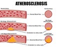 Atherosclerosis