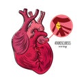 ATHEROSCLEROSIS DISEASE Chronic Illness Medicine Education Diagram