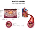 Atherosclerosis. Fibrous plaque formation Royalty Free Stock Photo