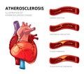 Atherosclerosis. Fibrous plaque formation. Vector infographic Royalty Free Stock Photo