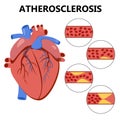 Atherosclerosis. The formation of fibrous plaque.  Infographics. Cholesterol in human blood vessels and heart logo. Fat cells in v Royalty Free Stock Photo