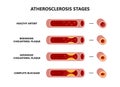 Atherosclerosis formation. Healthy and unhealthy arteries. Cholesterol plaque in the blood vessels.