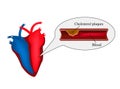 Atherosclerosis of the heart. angina pectoris. Heart disease. World Heart Day. Vector illustration on isolated background. Royalty Free Stock Photo