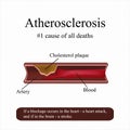 Atherosclerosis. High cholesterol in the blood. Blockage of an artery. Vector illustration