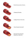 Atherosclerosis illustration. High cholesterol.