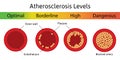 Atherosclerosis levels. The accumulation of cholesterol in the blood vessels. Atherosclerotic plaque. Artery anatomy Royalty Free Stock Photo