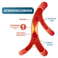 Atherosclerosis medical vector illustration cross section diagram, unhealthy blood vessel circulatory system disease.