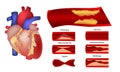 Atherosclerosis, a normal and painful condition of the arteries of the heart