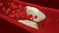 Atherosclerosis. Plaque builds up inside an artery. Blood cells. Royalty Free Stock Photo