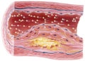 Atherosclerosis - Plaque