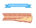 Atherosclerosis process on different stages from healthy vessel to fibroatheroma and complicated lesion Royalty Free Stock Photo