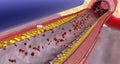 Atherosclerosis Progression in the Penis