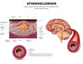 Atherosclerosis. Stable plaque formation