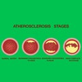 Atherosclerosis stages.The accumulation of cholesterol in the blood vessels. Atherosclerosis Royalty Free Stock Photo