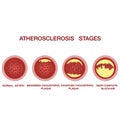 Atherosclerosis stages.The accumulation of cholesterol in the blood vessels. Atherosclerosis Royalty Free Stock Photo