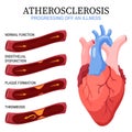 Atherosclerosis stages. Anatomy of heart attack. Arteriosclerotic vascular disease or ASVD. Atherosclerotic plaque in Royalty Free Stock Photo