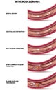 Atherosclerosis stages Royalty Free Stock Photo