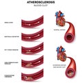 Atherosclerosis stages