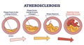 Atherosclerosis stages explanation and fatty plaque formation outline diagram