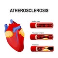 Atherosclerosis stages Royalty Free Stock Photo