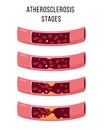 Atherosclerosis stages. Healthy and unhealthy arteries.