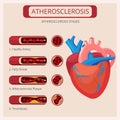 Atherosclerosis stages. Heart strokes thrombus attack blood circulatory system vector medical infographics Royalty Free Stock Photo