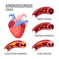 Atherosclerosis stages. Normal functions, endothelia disfunction, plaque formation, rupture thrombosis Royalty Free Stock Photo