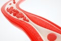 Angioplasty without stent placement- 3D rendering Royalty Free Stock Photo