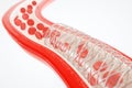 Angioplasty with stent placement- 3D rendering Royalty Free Stock Photo