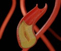 Atherosclerosis is thickening or hardening of the arteries caused by a buildup of plaque in the inner lining of an artery