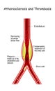 Atherosclerosis and Thrombosis