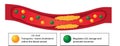 Atherosclerotic plaque in blood vessel