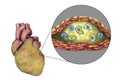 Atherosclerotic plaque in coronary blood vessel of obese heart, illustration