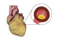 Atherosclerotic plaque in coronary blood vessel of obese heart, illustration