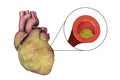 Atherosclerotic plaque in coronary blood vessel of obese heart, illustration