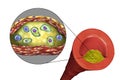 Atherosclerotic plaque in human artery