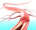 Athersclerosis in artery