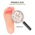 Athlete`s foot. fungal infection of Microsporum