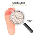 Athlete`s foot. fungal infection of Trichophyton
