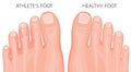 Athlete s foot and healthy foot top view