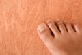 Athlete's foot, medically known as tinea pedis, fungal infection affecting the skin of the feet with such as itching, Royalty Free Stock Photo