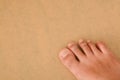 Athlete's foot, medically known as tinea pedis, fungal infection affecting the skin of the feet with such as itching, Royalty Free Stock Photo
