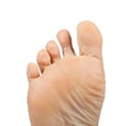 Athlete's foot, Tinea pedis Royalty Free Stock Photo