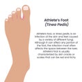 Athlete\'s Foot Tinea Pedis vector illustration vector infographic