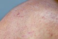 Atocpic dermatitis symptoms on the right shoulder