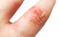 Atopic dermatitis (AD), also known as atopic eczema. Inflammation of the skin (dermatitis) on the fingers.