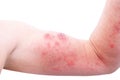 Atopic dermatitis AD, also known as atopic eczema, is a type of inflammation of the skin dermatitis at foot. Royalty Free Stock Photo