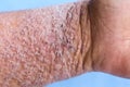 Atopic dermatitis AD, also known as atopic eczema, is a type of inflammation of the skin dermatitis. Royalty Free Stock Photo